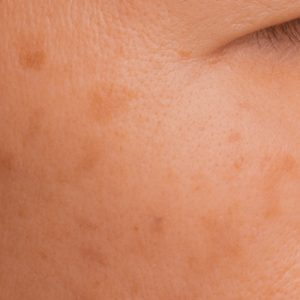 Tratamiento de manchas: Cosmelan de Mesoestetic