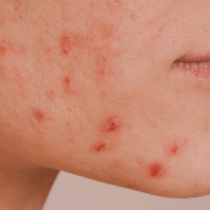 Tratamiento Acné: Acnelán Mesoestetic