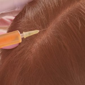 Tratamiento capilar con PRP Plasma Rico en Plaquetas