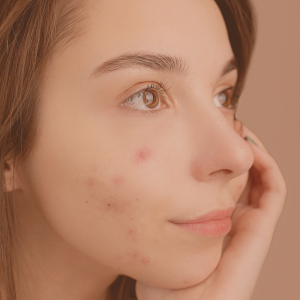 Acné Repair