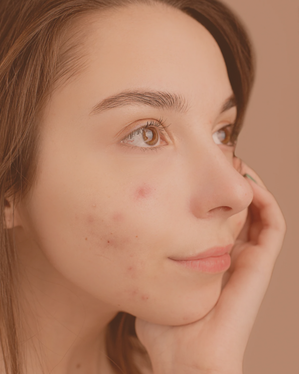 Acné Repair
